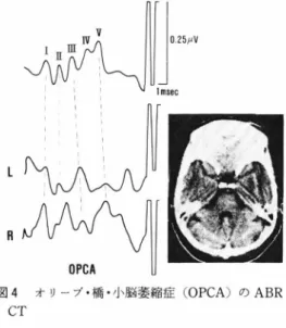 表 4 P a t i e n t s  with Abnormal  B l i n k  R e f l e x  i n  Brainstem and C e r e b e l l a r  Stroke ( Cases )  ABR A b n o r m a l i t y  L a t e r a l i z a t i o n  C l i n i c a o l f  L L o e c s a i l o i n z  a t i o n  Number oCases  f  A b n