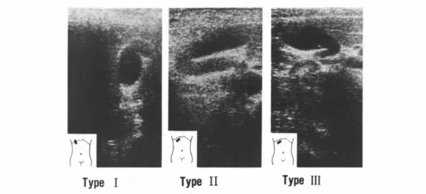 Table 5 R e l a t i o n   between  t h e   type  o f   f o l d e d   g a l l b l a d d e r  and  symptoms  Number  w i t h  〔 s 2 y 6 m 