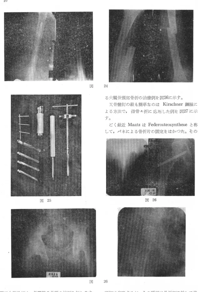 図 25 図 図 24 る大腿骨頸部骨折の治療例を図26に示す。  又骨髄釘の最：も簡単なのはKirschner鋼線に よる方法で，指骨A・折に応用した例を図27に示す。 ごく最近MaatzはFederosteosyntheseと称して，バネによる骨折片の固定をはかった。その26図 26 頸部内側骨折は，偽関節や骨頸の壊死を起しやす いが，本法によればこれを救い得る。三翼釘によ 詳細は省略するが，その原理は骨折部に対して働く圧力が骨形成に有用に働くことを利用したもの