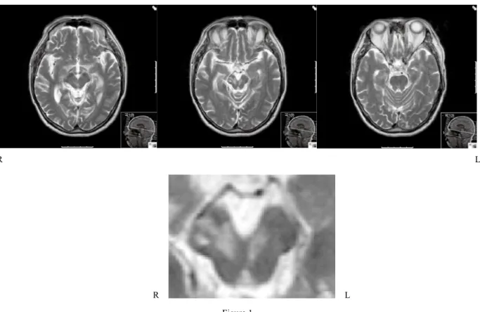 Figure 1. 症例の MRI T2 強調画像．下段は中脳の部分を拡大したものである．両側の中脳から橋にかけて梗塞巣が認められる。      L                                                                                                                                                                                      