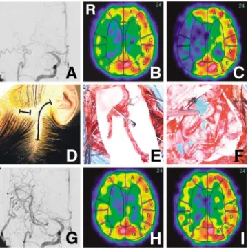 Fig. 2 Representative case. A 42-year-old male with left mild hemiparesis due to recent cerebral infarction was introduced to our clinic for cerebral revascularization