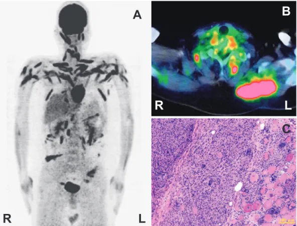 Figure 1. Fluorodeoxyglucose-positron emission tomography (PET) and biopsy of the muscle