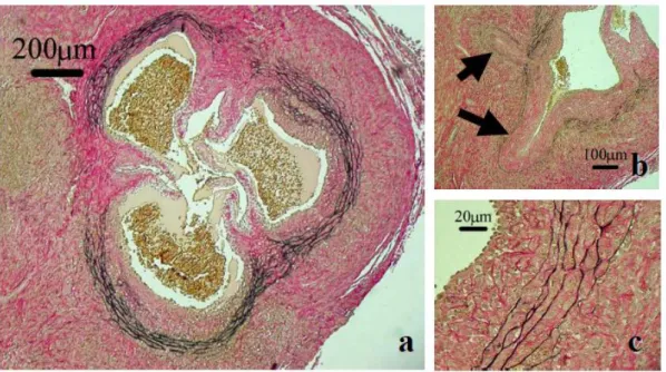 Fig. 1-5 CAWS血管炎のElastica Van Gieson（EVG）染色による病理組織像 