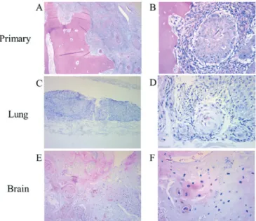 Figure 3. Representative imaging results of lung distant metastases. (A) Axial  chest computed tomography detected multiple pulmonary nodules 6 months  after concurrent chemoradiotherapy