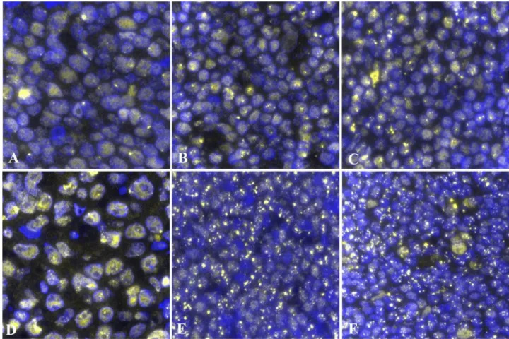 Figure 2.  Representative images of 53BP1 expression in benign and malignant lymphoid proliferative lesions