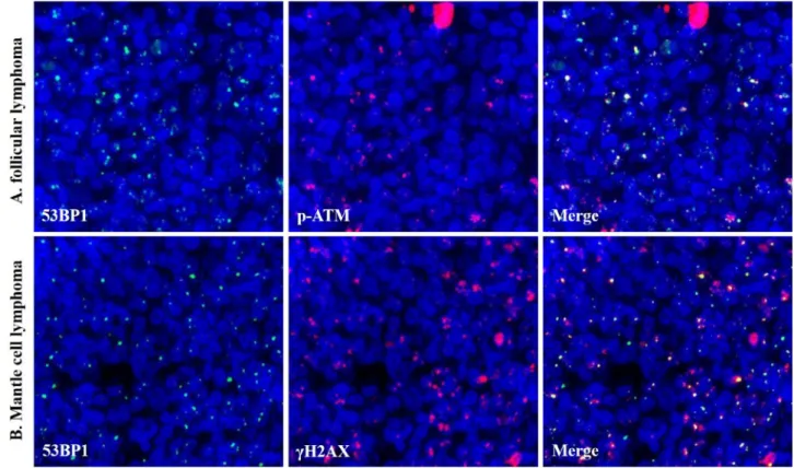 Figure 4.  Co-localization of 53BP1and DDR-related molecules. Co-localization of 53BP1 (green) and p-ATM  (orange) in follicular lymphoma grade 2 (A), and 53BP1 (green) and γH2AX (orange) in mantle cell lymphoma,  classical type (B) by dual-color immunoflu
