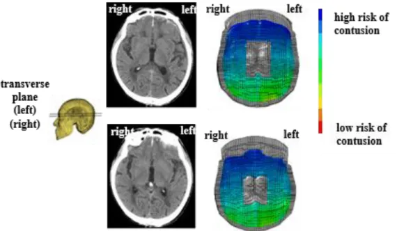 Fig. 5.2.2.2 A fall/fall down accident reconstruction and risk evaluation of head injuries 
