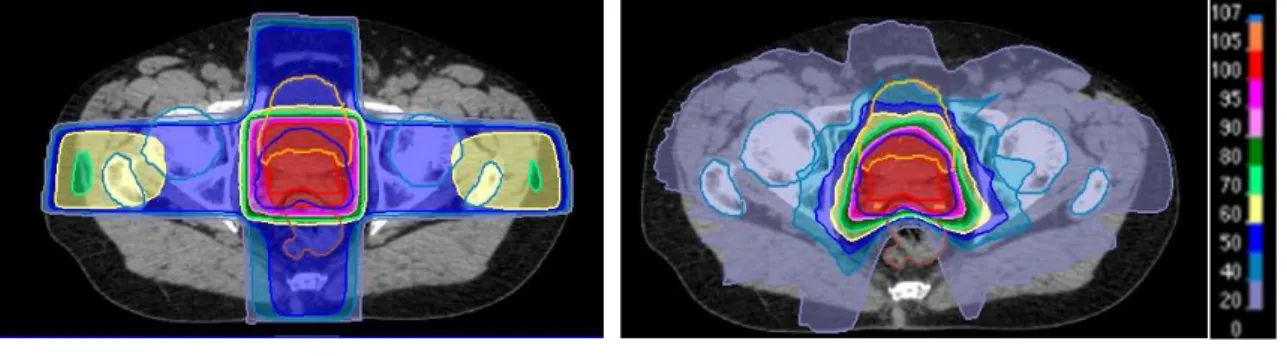 図 1.1 に前立腺癌に対する、 3 次元原体照射（3 dimensional conformal radiation therapy; 3D-