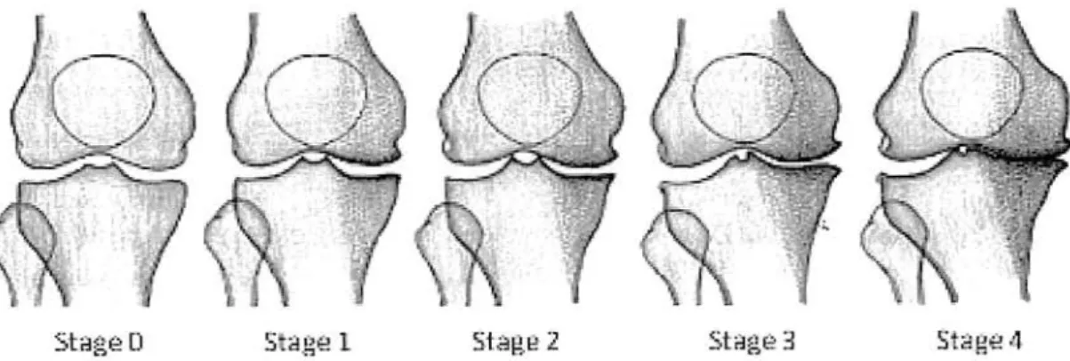 Figure  2-6  Schematic  illustration  of  Kellgren-Lawrence  Score 