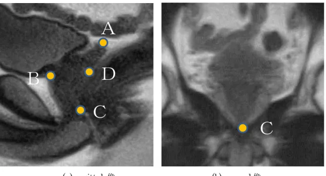 図 4.2(a)は sagittal 像,(b)  は coronal 像である。前立腺呼吸性移動の計測箇所を示す。 A は精嚢上部（以下、精嚢） 、B は内尿道孔前方、C は前立腺尖部、D は直腸壁前壁である。