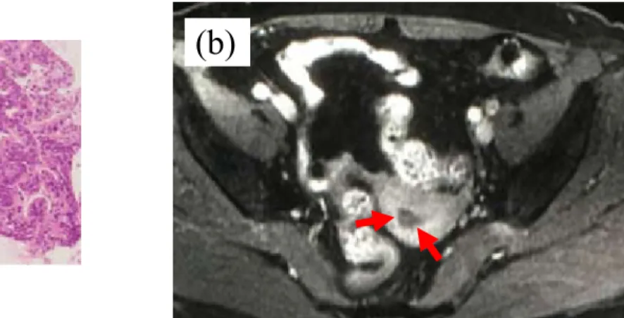 Figure 1. The ﬁndings of pathological examination and magnetic resonance imaging (MRI) before operation.