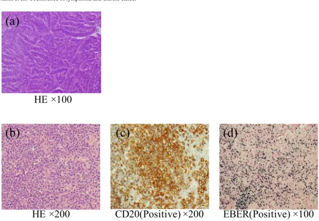 Figure 3. The pathological ﬁndings of uterus and left inner inguinal lymph node.
