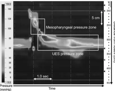 Figure 1: The typical graphic pattern during water swallowing. The two  squares demonstrate the zones of pressure measurement.