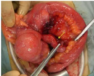 Figure 2.  Surgical  ﬁndings. A perforated inﬂamed appendix and  abscess formation around the appendix were conﬁrmed (arrow).