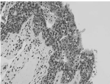 Figure 4.  The ﬁndings of HER-2 staining for the tumor. (A) No  immunostaining for HER-2 was observed in case 1 (x400)