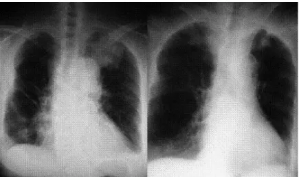Figure 1.  Chest X-ray at onset (A, left) and one year and 11 months after onset  (B, right)