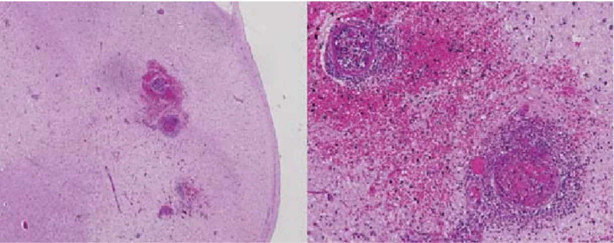Figure 6. Macroscopic image of interior surface of heart (A), HE stain of heart insection (B), and Gram stain of  verruca (C) in autopsy