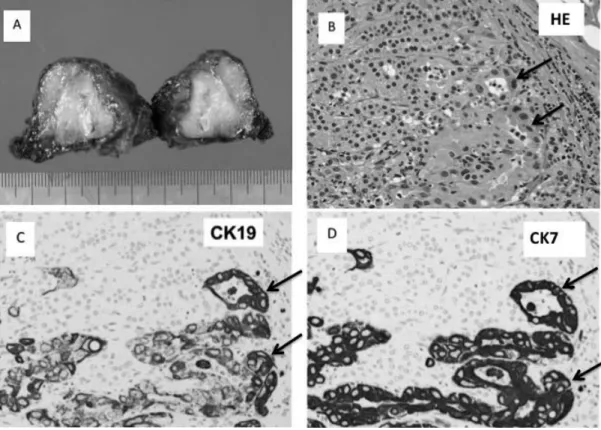 Figure 3B. Histologically, there were normal adrenocortical cells on the left upper side and atypical epithelial  cell proliferation with focal duct formation (arrow) on the right lower side