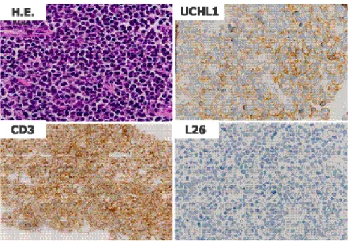 Figure 2. H.E. staining and immunostaining of the CT-guided transcutaneous mediastinal biopsy samples (high-power view)