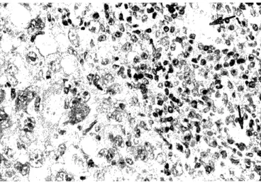 Figure  2.  Cell  infiltrate  rich  in  lymphocytes  in  the  periph- periph-ery  of  tumor  nodule