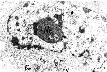 Figure  5.  Electron  micrograph  of  tumor  cell  with  prevail- prevail-ing  euchromatin  in  the  large  nucleus  and  big  nucleolus  (Nc)