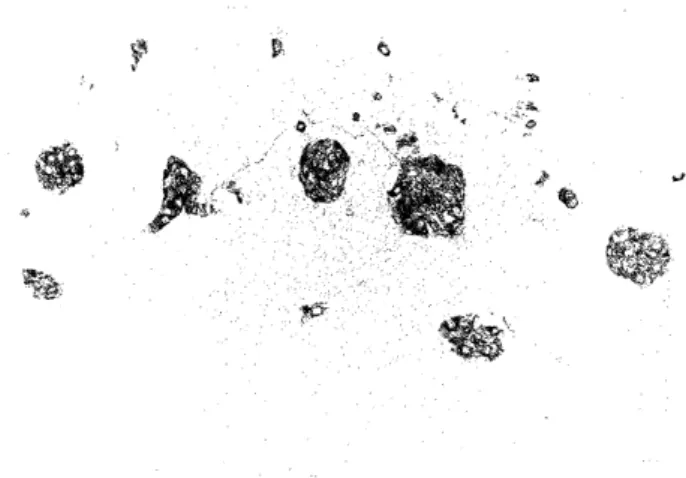 Figure  1.  (A)  Carcinoid  tumors  illustrating  a  trabecular  or  al- al-veolar  pattern  with  ribbon-like  structures