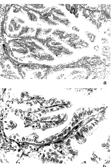 Figure  2.  Endoscopic  retrograde  cholangiogram  showed  a  fill-