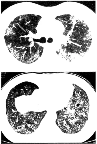 Figure  3.  Specimen  obtained  by  thoracoscopic  lung  biopsy  showing  a  mild  degree  of  intra-airspace  organization,  the  presence  of  minimal  fibrosis,  and  subpleural  honeycombing  with  loss  of  alveolar  structure