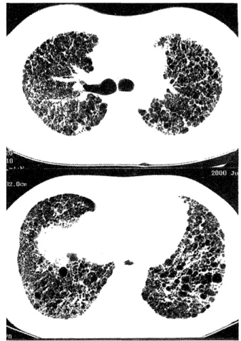 Figure  4.  Chest  X-ray  taken  in  2000  showing  diffuse  reticu- reticu-lar  opacities  and  elevation  of  both  domes  of  the  diaphragm  indicative  of  lung  volume  loss.