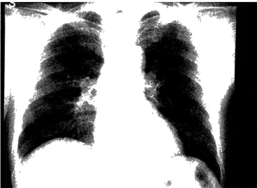 Figure  1.  Chest  X-ray  film  taken  on  admission.  Note  almost  normal  lung  fields.