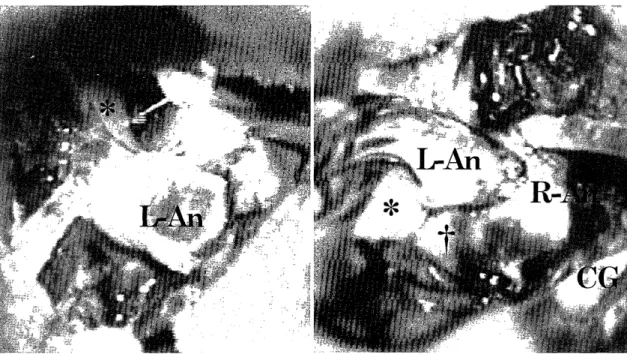 Figure  3.  Intraoperative  photograph.  The  aneurysm  of  the  left  ACA  is  exposed  (left)