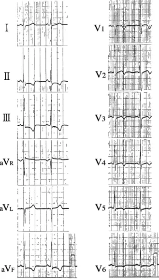 Fig.  2.  Electrocardiogram  on  June  3,  1998. 