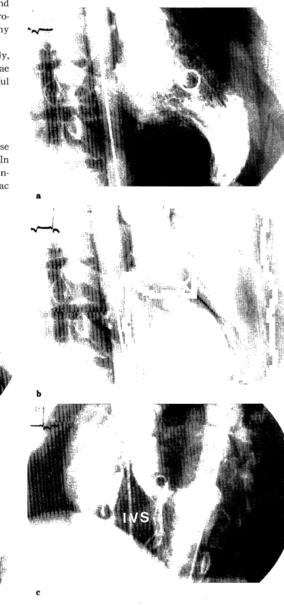 Fig.  4.  Coronary  angiogram  on  June  17,  1998. 
