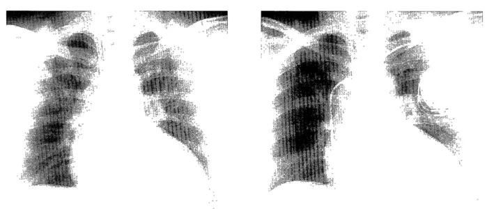 Fig.  1.  Chest  X-ray.  Left,  before  implantation  of  pacemaker  (CTR:  63.7%);  right,  after  single-lead  VDD  pacemaker  implan- implan-tation  (CTR:  61.0%)