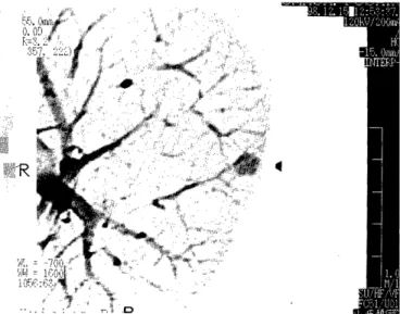Figure  1.  Computed  tomography  of  the  chest.  Note  a  nodular  ground-glass  opacity  in  the  subpleural  region  of  left  lung(B'+2,  arrowhead).