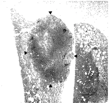 Figure  2.  Low  power  view  of  the  nodule.  The  tumor  is  cir- cir-cumscribed  but  not  encapsulated  (arrowhead