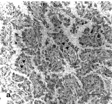 Figure  5.  a)  Tumor  cells  are  positive  for  surfactant  apoprotein  A  (arrowhead,  bar;  50  fi m).