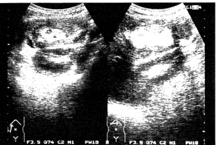 Fig  2.  Case  1.  Abdominal  CT  demonstrating  a  complex  colonic  mass  composed  of  a  fat  layer,  intestinal  fluid,  and  bowel  wall.