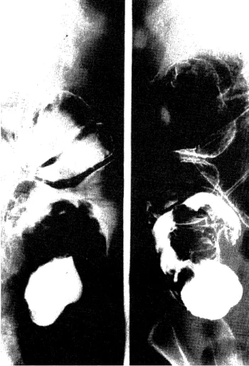 Fig  6.  Case  2.  Barium  enema  showing  the  beak-like  filling  defect  in  the  ascending  colon,  suggestive  of  intussusception.