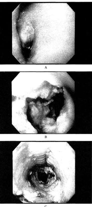Fig.  2  represents  a  70-year  old  man  with  squamous  cell