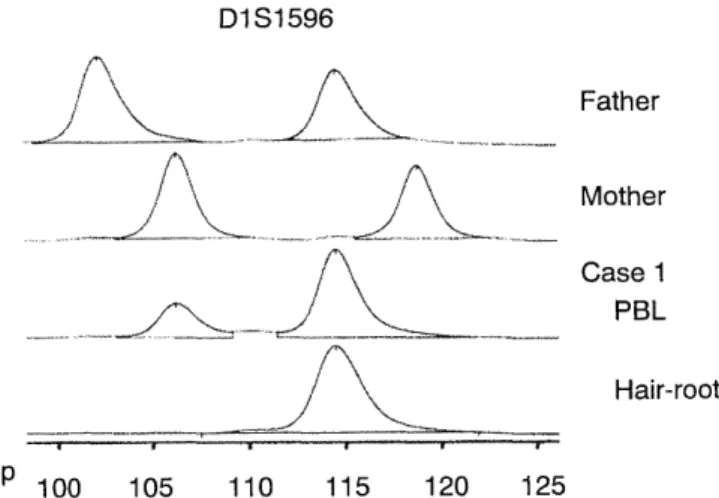Fig  2.  Electrophoretic  patterns  of  CA-repeat  polymorphic  al- al-leles  at  the  D1S1596  locus  in  the  family  of  Case  1.