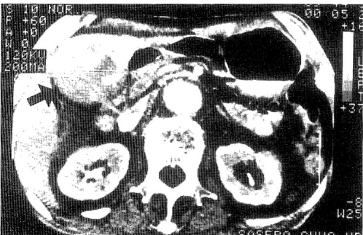 Fig.  3.  Resected  specimen  of  case  3  showing  7  x  6  cm  encap- encap-sulated  massive  tumor  with  3  cm  pedicle.