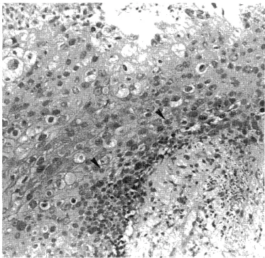 Figure  1.  Apoptotic  cells  (arrow  head)  are  characterized  by  loss  of  cell  volume  and  condensation  of  chromatin