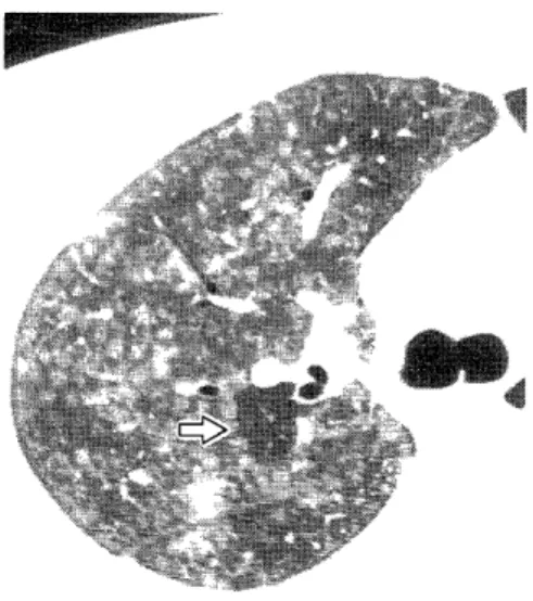 Fig.  3.  III -defined  centrilobular  nodules  associated  with  diffuse  ground-glass  opacity  is  depicted  in  a  patient  with  acute  hypersensitivity  pneumonitis