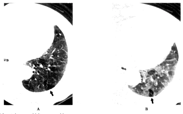 Fig.  5.  Subacute  hypersensitivity  pneumonitis. 