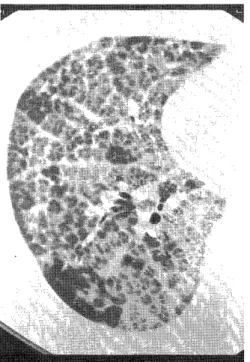 Fig.  9.  UIP  associated  with  rheumatoid  arthritis. 
