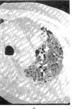 Fig.  10 A,  B.  Accelerated  deterioration  of  UIP  associated  with  rheumatoid  arthritis