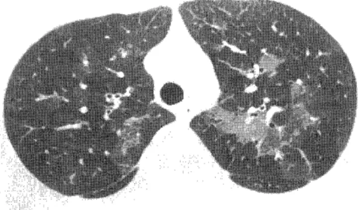 Fig.  13.  Constrictive  bronchiolitis  in  an  allograft  bone  marrow  trasplant  recipient
