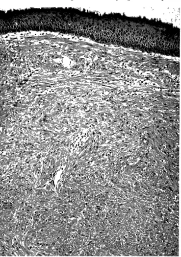 Fig.  1  Case  1.  Barium  meal  showing  a  filling  defect  with  smooth  edges  in  the  lower  esophagus.