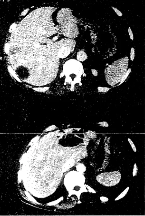 Fig.  2.  Contrast-enhanced  CT  scan  showing  papillary  projec- projec-tion  with  enhancing  effect  in  the  multilocular  cyst  (Case  1).